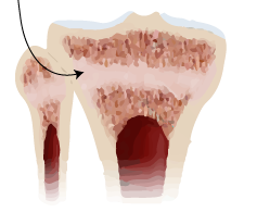 bone-growth-plate. open.png?144170822795